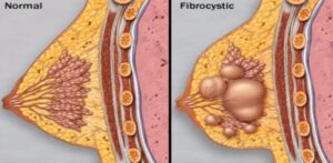 A mastopathia egy emlőmirigy-betegség, amelyet ciszták képződése és fibrotikus elváltozások jellemeznek az emlőszövetben. Ezek a változások lehetnek fibrocisztás területek, rostos csomók vagy ciszták. Ez az állapot sok nőt érint, és számos tünetet okozhat, beleértve a fájdalmat, érzékenységet és kellemetlen elváltozásokat a mellekben. Az indol-3-karbinol hasznos a mastopathia kezelésében, mert segít fenntartani a hormonok egyensúlyát, ezáltal csökkenti a fibrocisztás elváltozások valószínűségét az emlőkben.